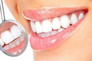 لمینت دندان | لمینت دندان در تهرانسر
