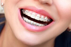 بهترین متخصص ارتودنسی ثابت در تهرانسر