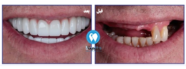 قبل و بعد طرح لبخند هالیوودی