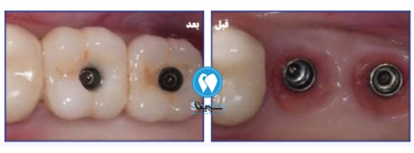 قبل و بعد ایمپلنت کره ای مگاژن
