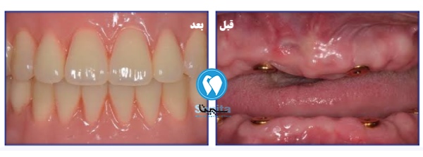 قبل و بعد ایمپلنت کرهای؛ بررسی مزایا و معایب
