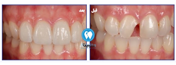 قبل و بعد شکستگی ونیر کامپوزیت