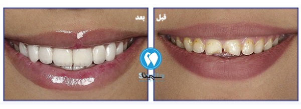 قبل و بعد لمینت سرامیکی