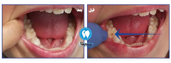 هزینه و بعد و قبل پر کردن دندان برای کودکان