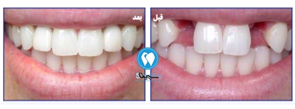 قبل و بعد پروتز دندان