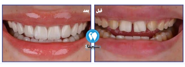 نمونه قبل و بعد لمینت سرامیکی دندان در تهرانسر