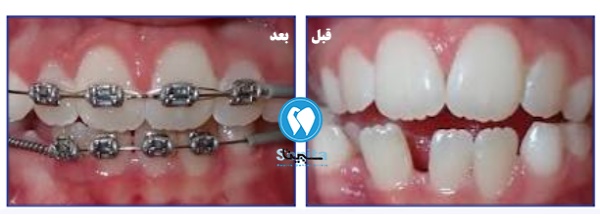 نمونه قبل و بعد ارتودنسی کودکان برای دندانهای نامرتب