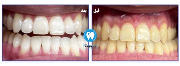 قبل و بعد بلیچینگ فوری دندان