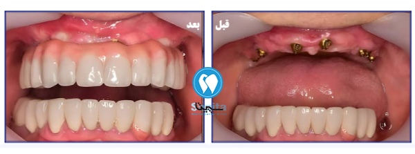 عکس قبل و بعد ایمپلنت دندان در کلینیک سپیتا