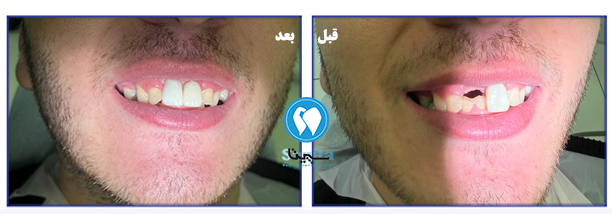 عکس قبل و بعد ایمپلنت دندان