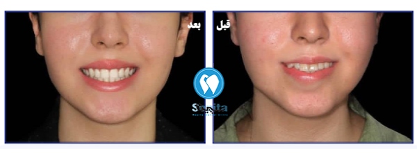 عکس قبل و بعد ارتودنسی ثابت