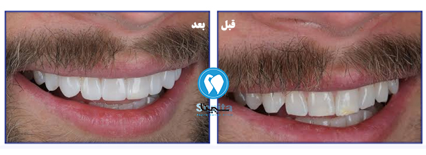 عکس قبل و بعد کامپوزیت دندان طبیعی
