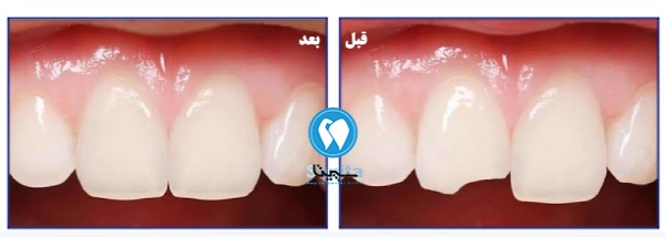 قبل و بعد ترمیم کامپوزیت شکسته در تهرانسر