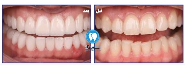 قبل و بعد طرح لبخند