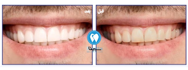 قبل و بعد بلیچینگ دندان