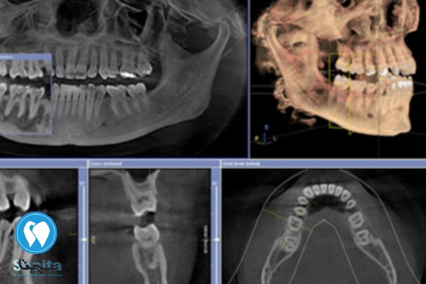تصاویر CBCT از هزینه های جانبی ایمپلنت دندان
