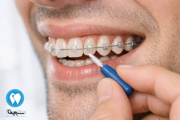 عوارض ارتودنسی ثابت