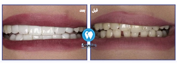 عکس قبل و بعد کامپوزیت