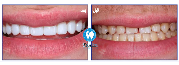 کامپوزیت دندان قبل و بعد