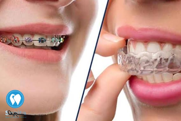 ارتودنسی متحرک بهتر است یا ثابت؟