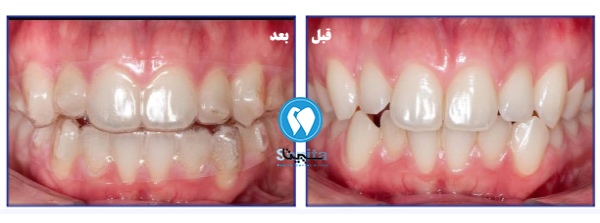 عکس ارتودنسی متحرک قبل و بعد