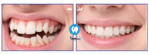 عکس های قبل و بعد ارتودنسی دندان