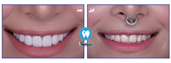 عکس کامپوزیت دندان در تهرانسر