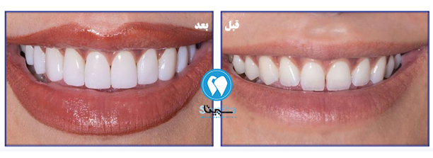 اصلاح طرح لبخند قبل و بعد