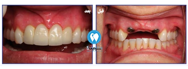 قیمت ایمپلنت سوئیسی به همراه نمونه قبل و بعد