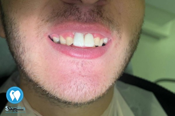 تفاوت متخصص ایمپلنت با دندانپزشک عمومی