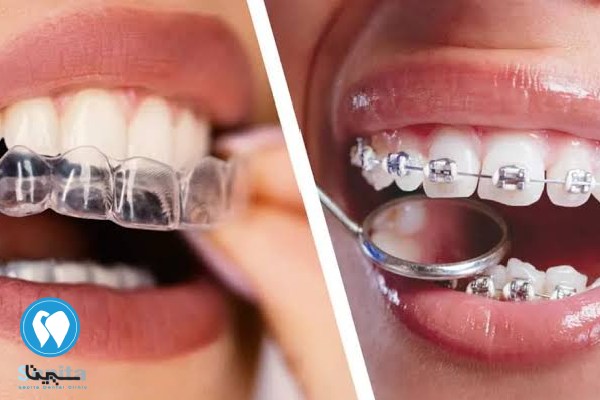 تفاوت ارتودنسی ثابت و متحرک