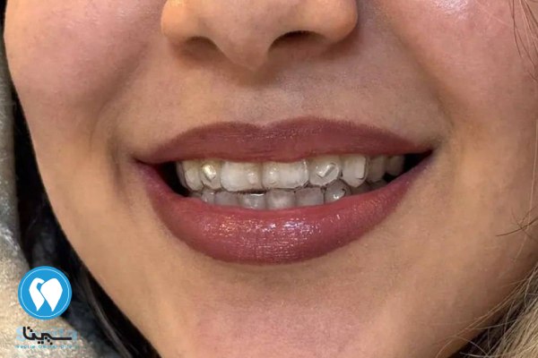 ارتودنسی متحرک چیست؟