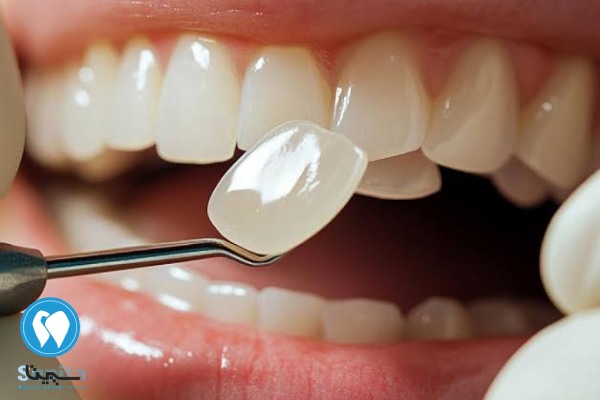 لمینت زیرکونیا