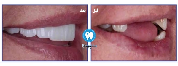 قبل و بعد ایمپلنت دندان جلو