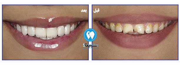 قبل و بعد لمینت دندان در کلینیک سپیتا