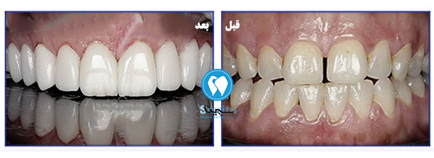 قبل و بعد لمینت دندان در کلینیک سپیتا