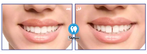 قبل و بعد کامپوزیت دندان فاصله دار در تهرانسر
