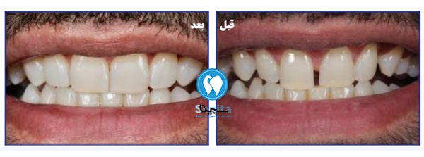 قبل و بعد کامپوزیت دندان فاصله دار
