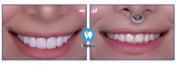 قبل و بعد کامپوزیت توسط دکتر کامپوزیت سپیتا