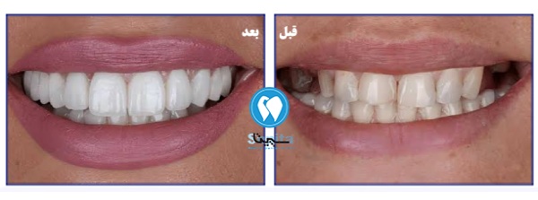 قبل و بعد ایمپلنت دندان دیجیتال در تهرانسر