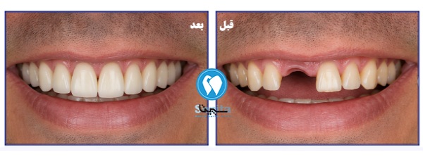 قبل و بعد ایمپلنت دیجیتال در کلینیک سپیتا