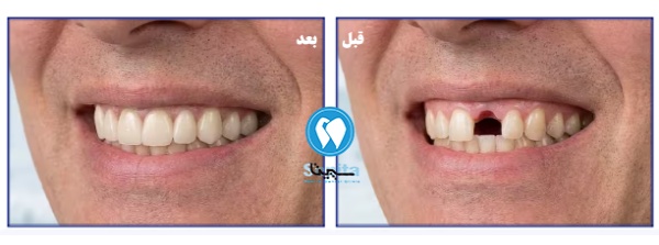 قبل و بعد درمان ایمپلنت فوری 