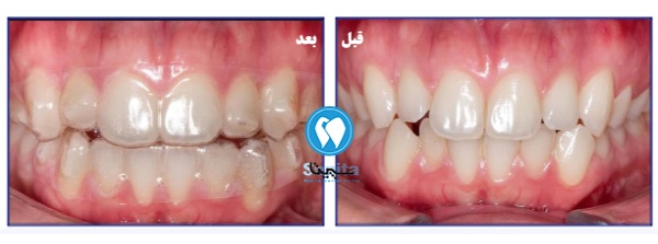قبل و بعد از ارتودنسی نامرئی