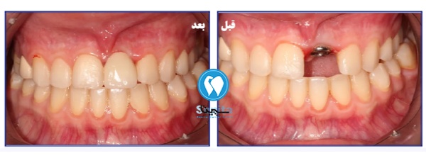 قبل و بعد ایمپلنت یک روزه در تهرانسر