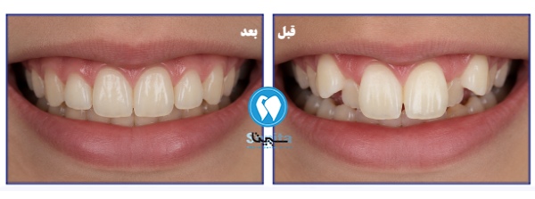 قبل و بعد ارتودنسی دندان خرگوشی