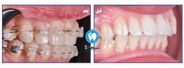 قبل و بعد ارتودنسی دندان خرگوشی در تهرانسر
