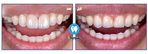 عکس قبل و بعد لمینت دندان خرگوشی