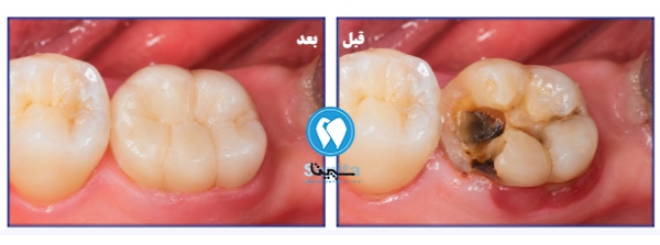 قبل و بعد عصب کشی دندان