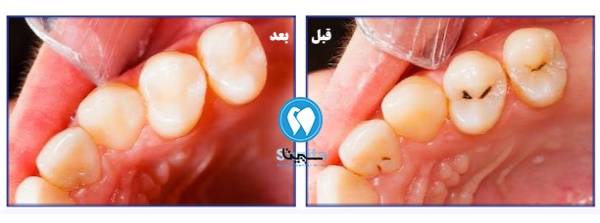 قبل و بعد ترمیم دندان