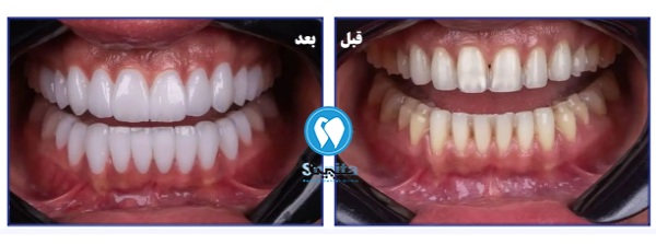 مقایسه ظاهر دندانها قبل و بعد از لمینت در سن مناسب